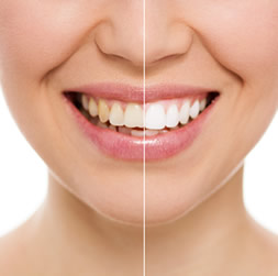 Teeth Whitening Image that is available at our practice.